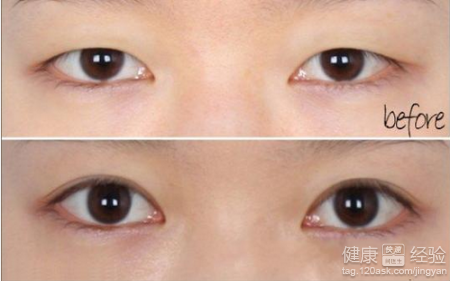 微創開眼角手術過程
