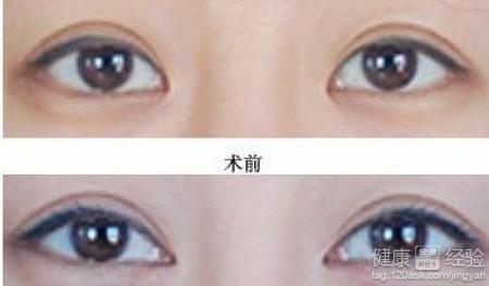 男生開眼角多少錢