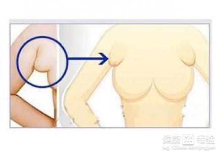 副乳不做手術能消除嗎
