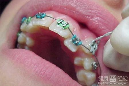 牙齒矯正會有哪些後遺症？